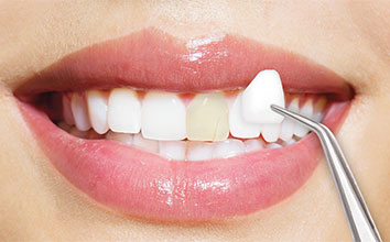 Porselen Veneer Diş Nasıl Yapılır