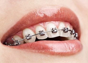 Braces Cost - Dentram Dental Clinics