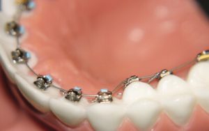 Lingual Ortodonti Tedavisi