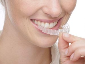 Şeffaf Plak İnvisalign