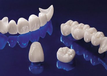 Zirkonyum Diş Kaplamanın Ortalama Kullanım Süresi