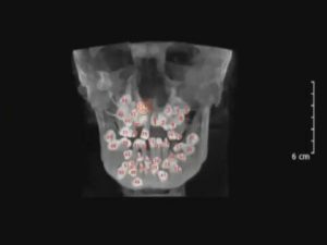 Ağzında 85 Diş Olan Hastamızın Öyküsü