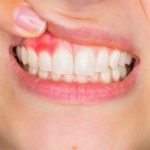 Suggestions for Gum Health