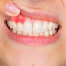 Suggestions for Gum Health