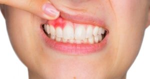 Signs of health gums