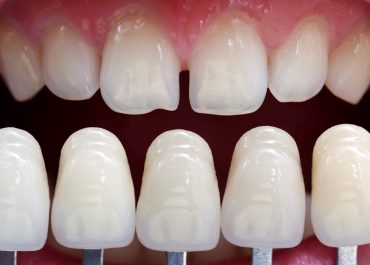 Porselen Diş Kaplaması Tedavisi