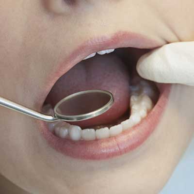 8 Simple Ways to Prevent Tooth Decay