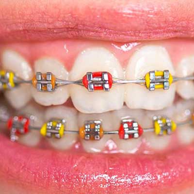 How Much Do Braces Cost?  Lakemoor Dental & Orthodontics