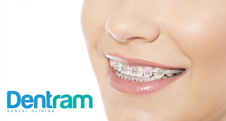 Braces Cost - Dentram Dental Clinics