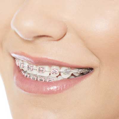 Braces Cost