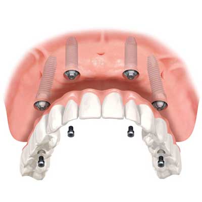 Cost of All-on-4 Dental Implants