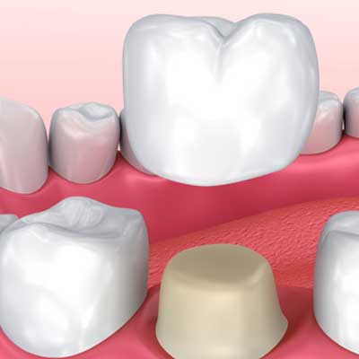 Dental Crowns – The Ultimate Guide