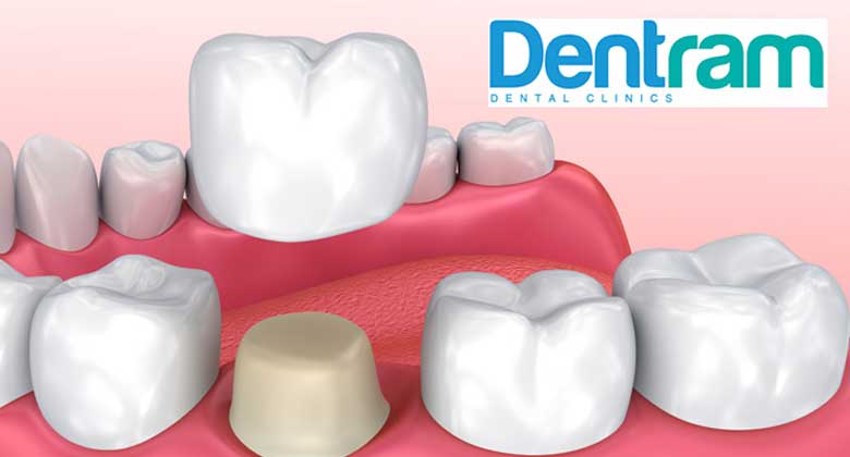 Dental Crowns – The Ultimate Guide