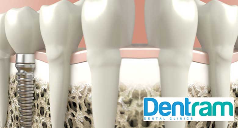 Dental Implant