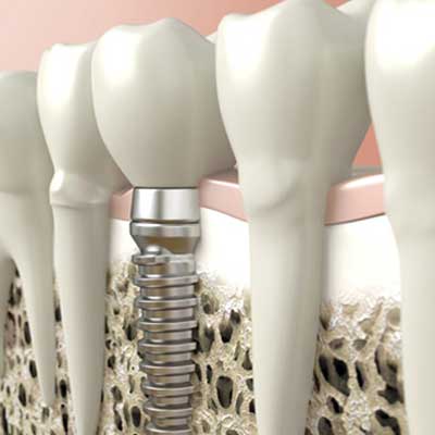 Dental Implant