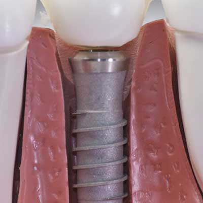 Dental Implants: Types, Pain, Cost