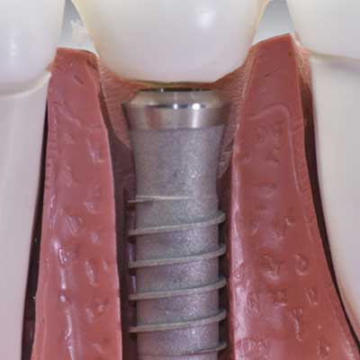 Dental Implants: Types, Pain, Cost