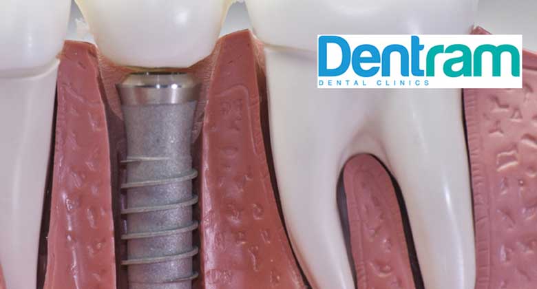 Dental Implants: Types, Pain, Cost