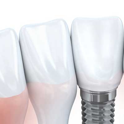 Dental Implant Average Cost