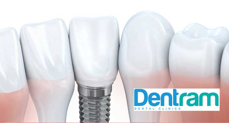 Dental Implant Average Cost