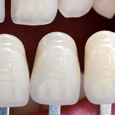 How Make Porcelain Veneers