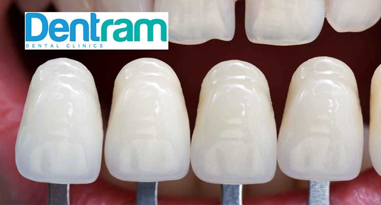 How Make Porcelain Veneers