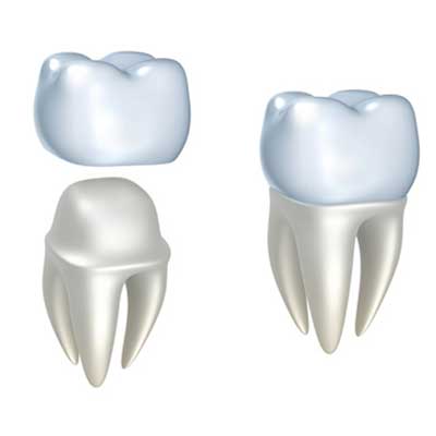 How Much Does a Dental Crown Cost ?