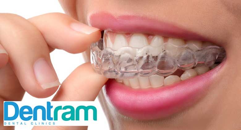 Invisalign Cost