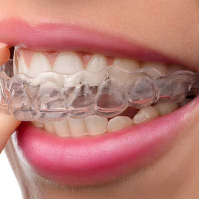 Invisalign Cost