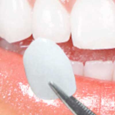 Porcelain Veneers on Teeth