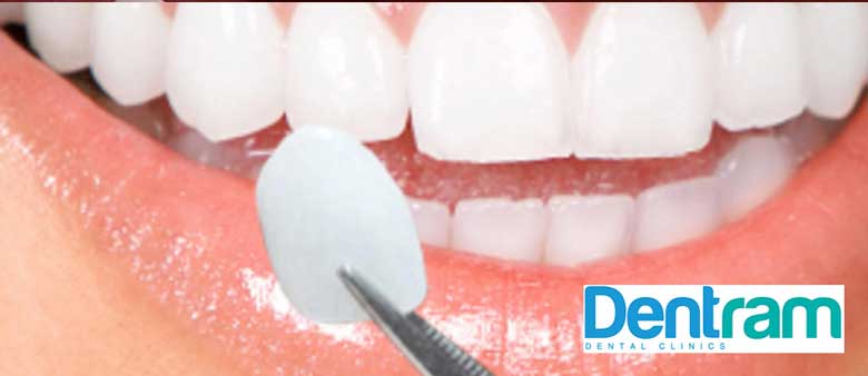 Porcelain Veneers on Teeth