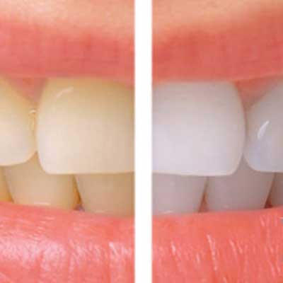 Professional Teeth Whitening Cost in Turkey