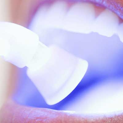 Teeth Whitening in Dentist