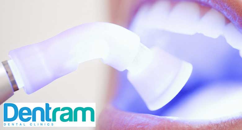 Teeth Whitening in Dentist