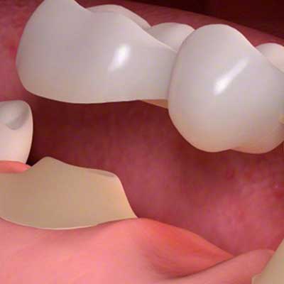 What is a Dental Bridge ?