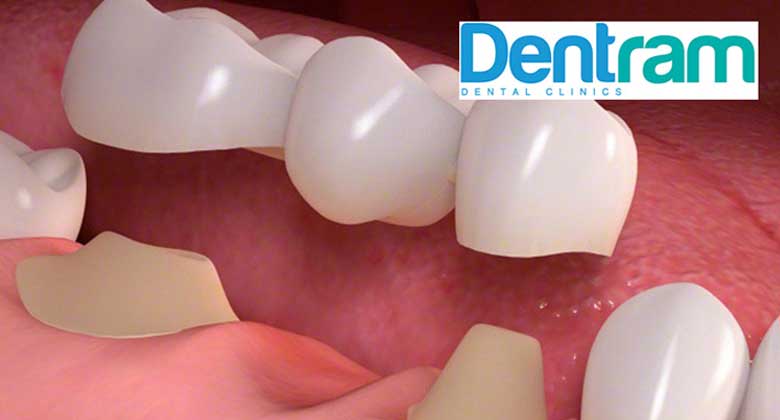 What is a Dental Bridge ?