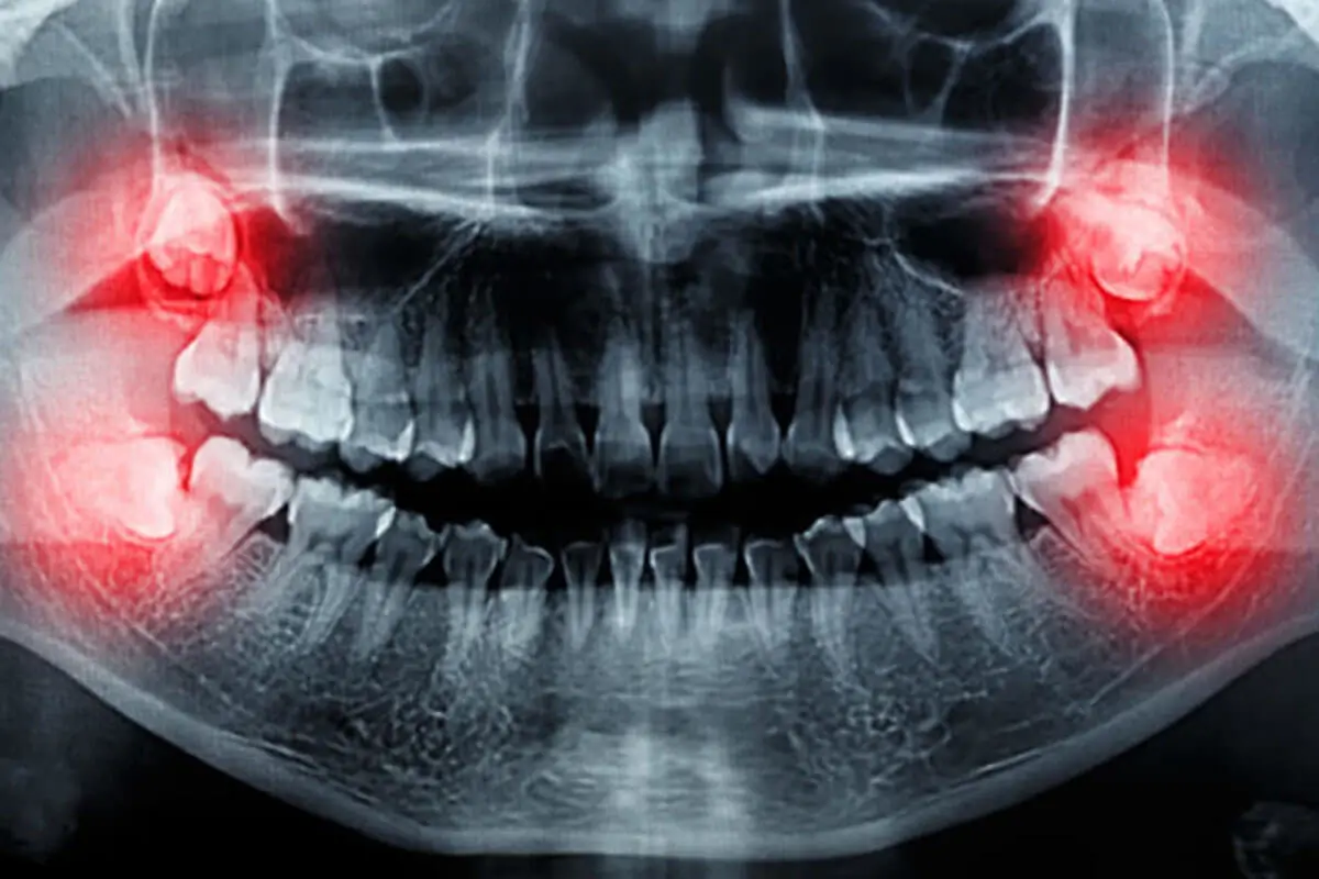 Panoramic X-ray of wisdom teeth
